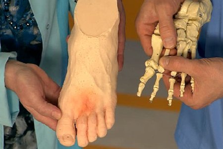 Перелом плюсневой кости стопы – как долго заживает травма