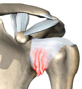 симптомы плечевого артрита