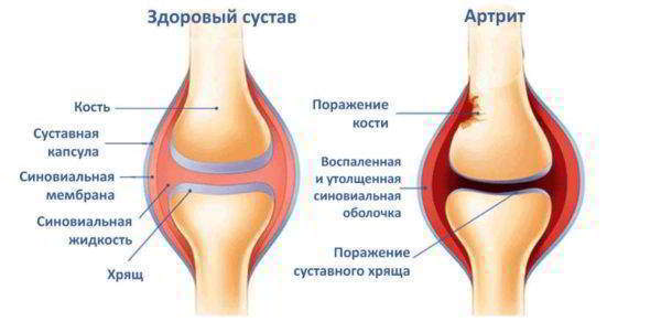 Признаки развития артрита колена