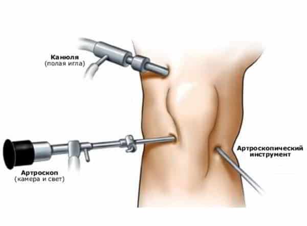 Артроскопия мениска коленного сустава