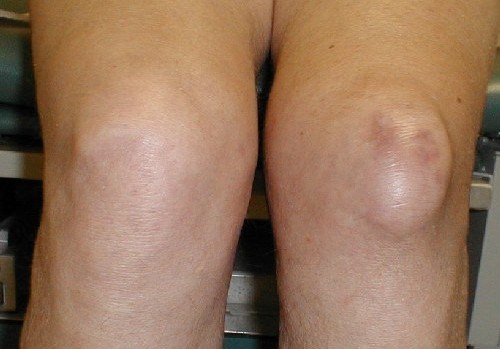 Препателлярный бурсит коленного сустава
