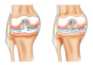 Повреждение мениска коленного сустава2