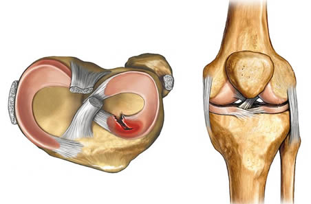 Повреждение мениска коленного сустава9