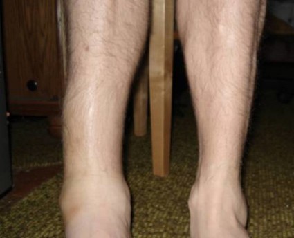 Вывих голени – это травма со смещением большеберцовой кости