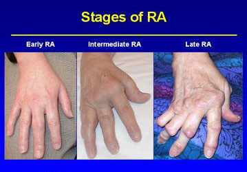 rheumatoid arthritis affected joints