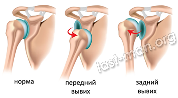 Вывихи плеча