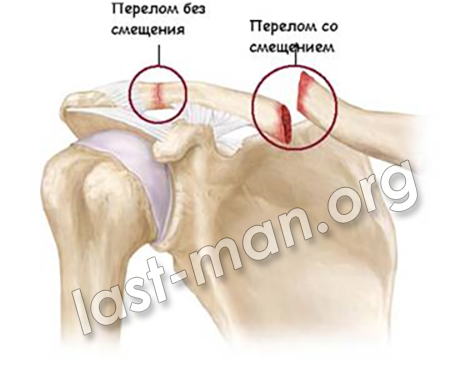 Перелом ключицы