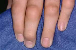 ревматоидный артрит у ребенка, детские руки с симптомами артрита