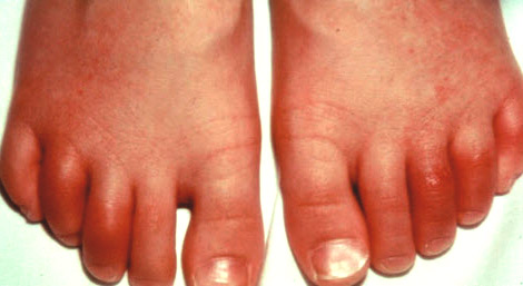 Артрит пальцев ног: причины, симптомы, лечение. 