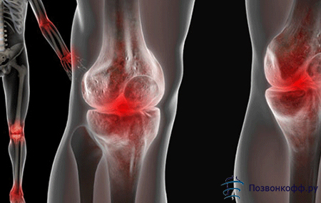 Артроз коленного сустава 1 степени: остановите болезнь вовремя!