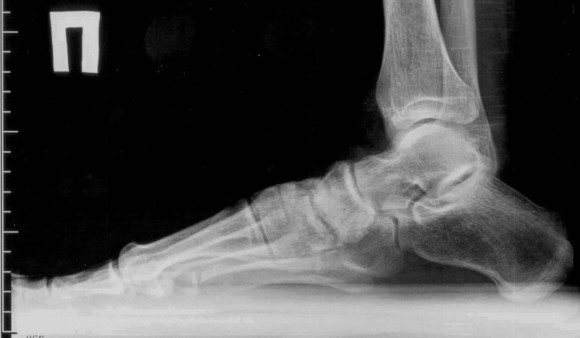 Артроз пальцев ног и стопы