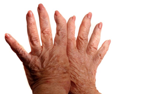 Остеоартроз кистей рук