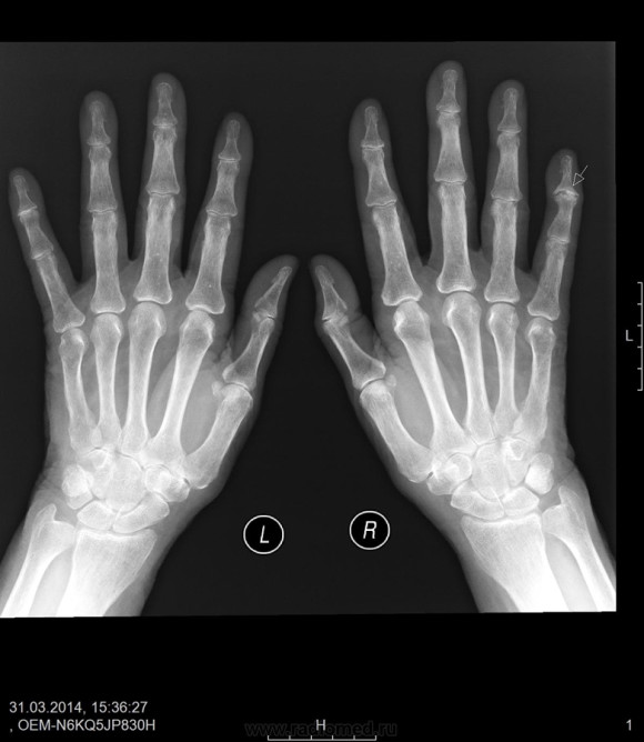 Рентген рук