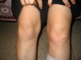 Воспаление мениска коленного сустава: как появляется ...