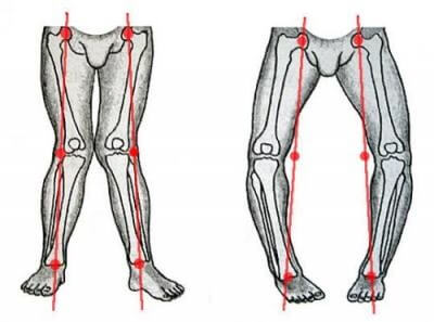Вальгусная и варусная деформация коленных суставов: лечение и ...