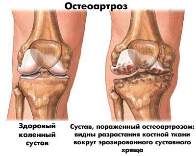 Остеоартроз коленного сустава лечится или залечивается?