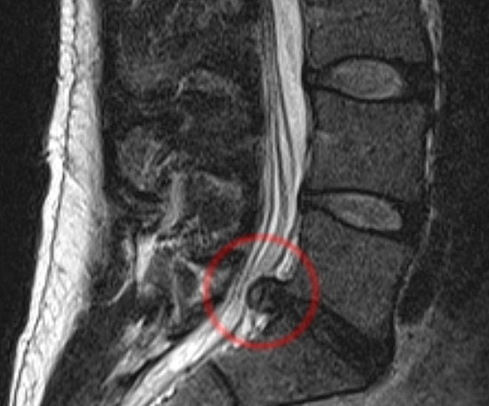 На снимке МРТ красным выделена область позвоночника с грыжей