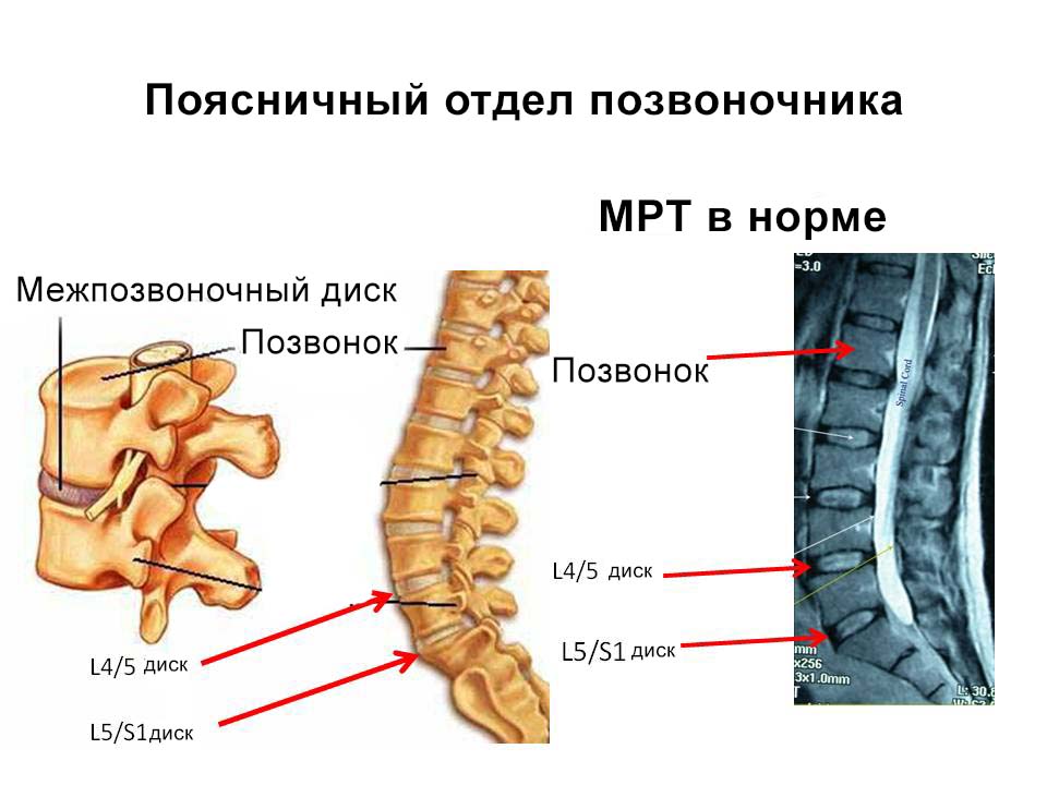 На картинке изображен здоровый позвоночник визуально и на снимке МРТ