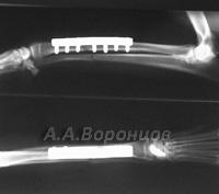 Поперечный перелом лучевой и локтевой костей со смещением у собаки