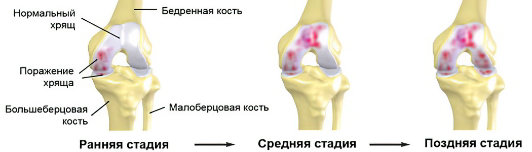 Артроз 1 степени коленного сустава