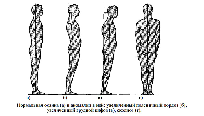 Рассмотрите рисунки 1 4 на каком из них изображен подросток с нормальной осанкой