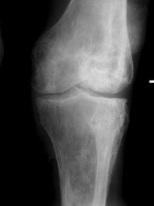 Болит коленный сустав - остеоартроз коленного сустава и лечение ...
