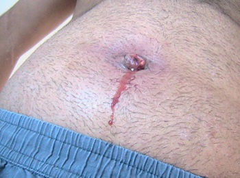 Кровь из пупка после операции