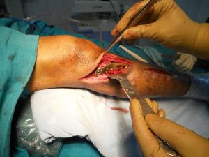 Хирургическое лечение перелома берцовой кости