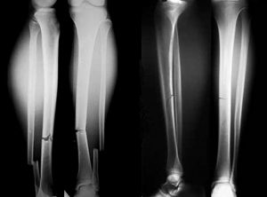 Рентген малой и большой берцовой кости при переломе