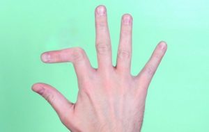 Особенности перелома пальца на руке