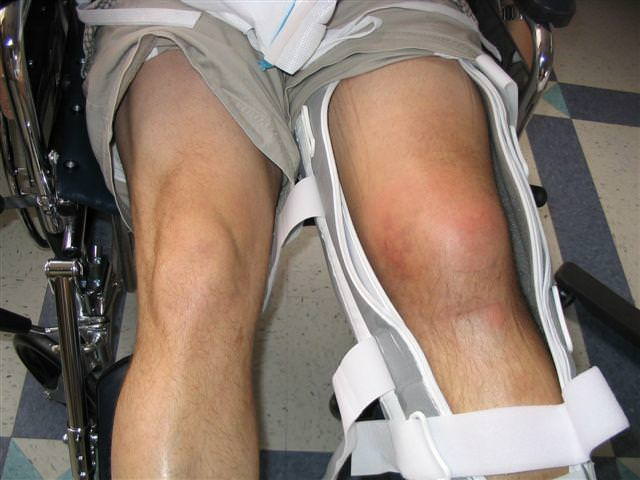 Поврежденное колено