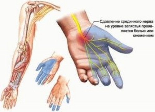 Сдавливание нервных окончаний – причина онемения левой руки