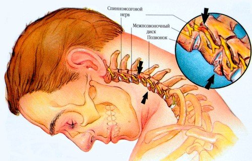 Самая распространённая грыжа шейных позвонков поражает шестой шейный позвонок