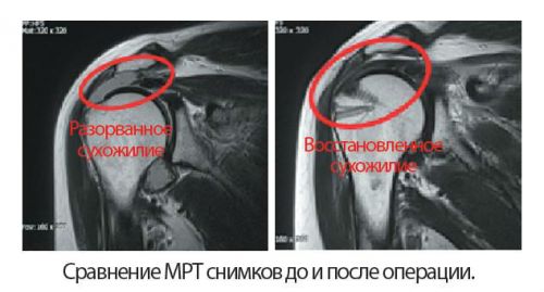 Разрыв сухожилия плеча