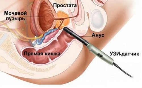 Трансректальное УЗИ