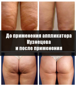 Аппликатор Кузнецова при целлюлите, фото до и после