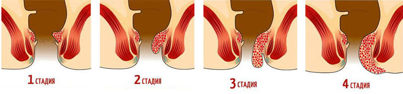 Геморрой - это процесс, при котором происходит воспаление прямой кишки, стадии геморроя