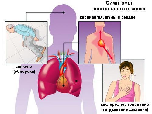 aortalnyj-stenoz-1