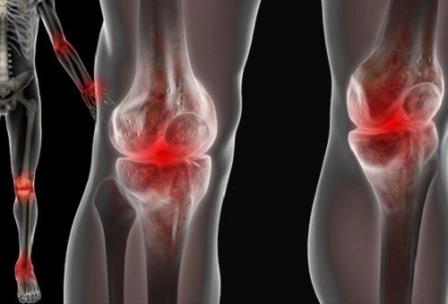 инстраграма больных суставов колен