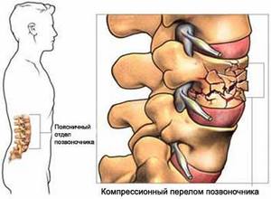 Перелом позвоночника