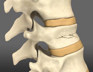 Признаки перелома позвоночника