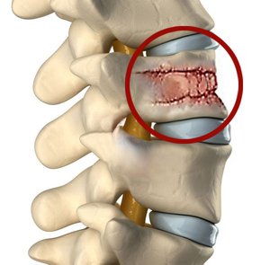 Лечение при при переломе позвоночника