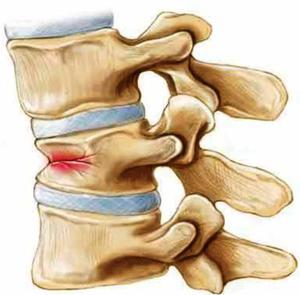 Как лечат компрессионный перелом позвоночника