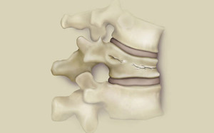 Перелом позвоночника