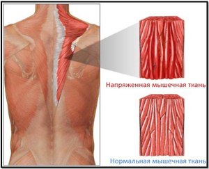 Как лечить миалгию