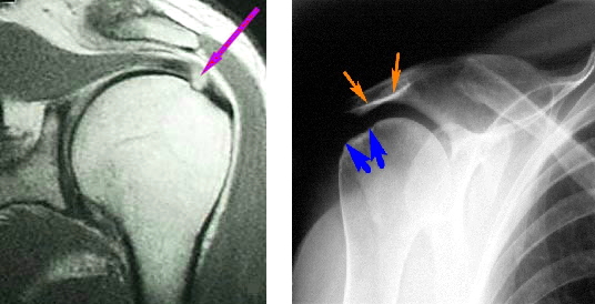 МРТ и рентгенскопия плечевого сустава
