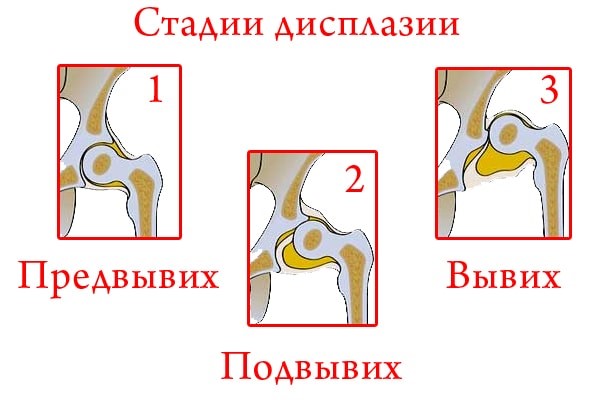 Стадии дисплазии