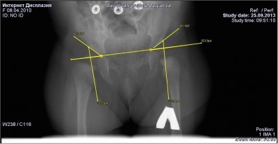 Недоразвитие тазобедренных суставов у грудничков
