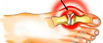 Болит сустав на большом пальце ноги
