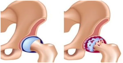 Признаки ДОА тазобедренного сустава